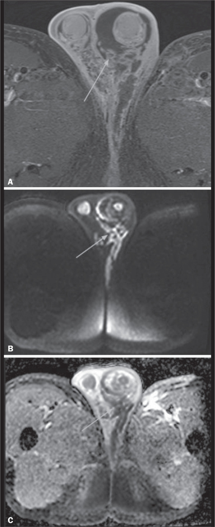 Non-neoplastic and neoplastic scrotal pathologies on magnetic resonance imaging: a pictorial essay.