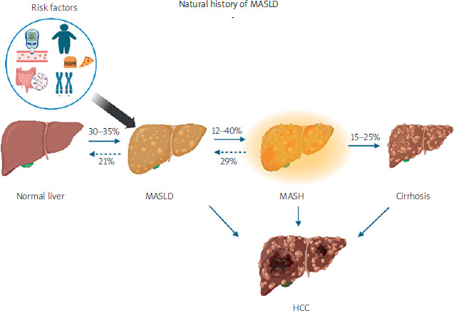 Exploring synergistic therapy for metabolic dysfunction-associated steatotic liver disease.