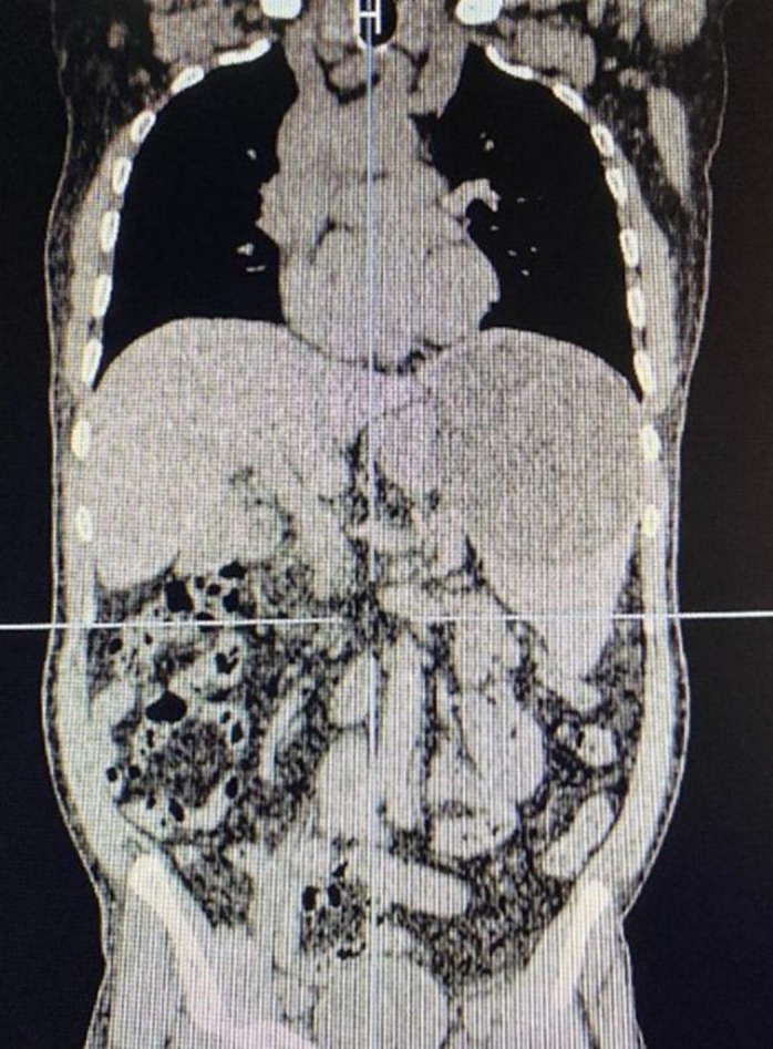 Peritoneal Hydatid Cyst Mimicking Peritoneal Seeding; A Case Report.