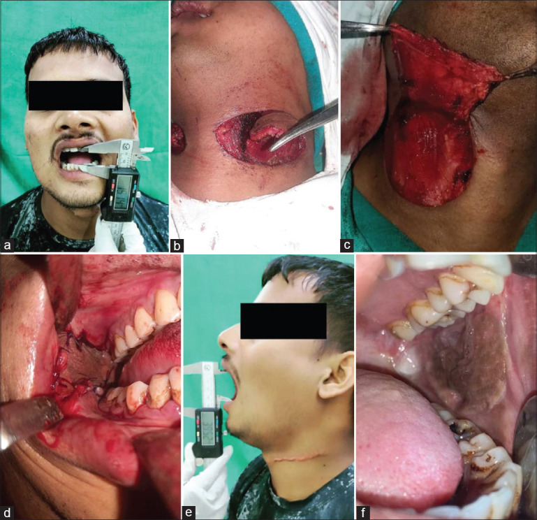 Utility of Platysma Myocutaneous Flap and Extended Nasolabial Flap in the Surgical Management of Oral Submucous Fibrosis - A Prospective Study.