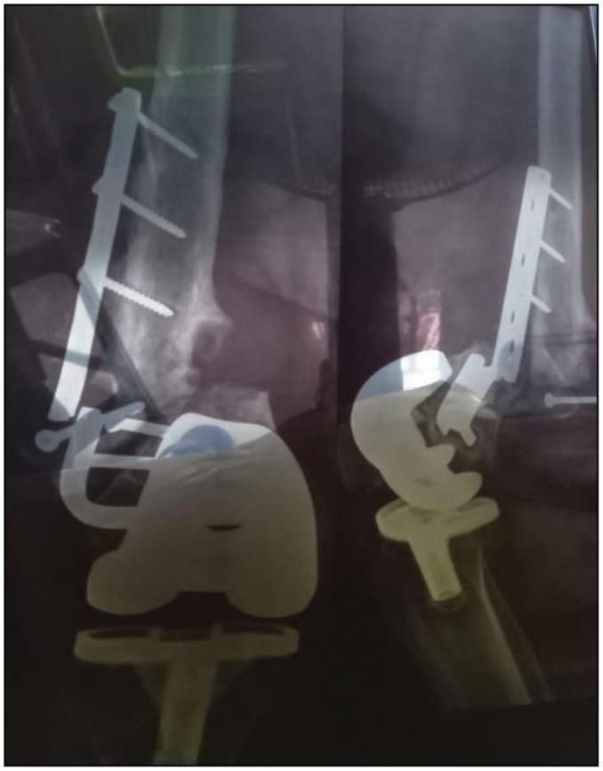 Total Femur Replacement as a Salvage Procedure for Failed Distal Femur Megaprosthesis: A Case Report and Literature Reviews.