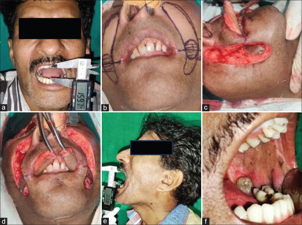 Utility of Platysma Myocutaneous Flap and Extended Nasolabial Flap in the Surgical Management of Oral Submucous Fibrosis - A Prospective Study.