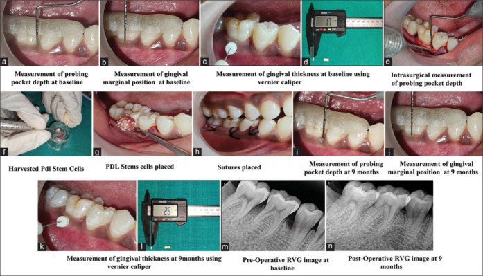 Evaluation of autologous periodontal stem cells niche in the treatment of periodontal intrabony defects: A split-mouth randomized controlled trial.