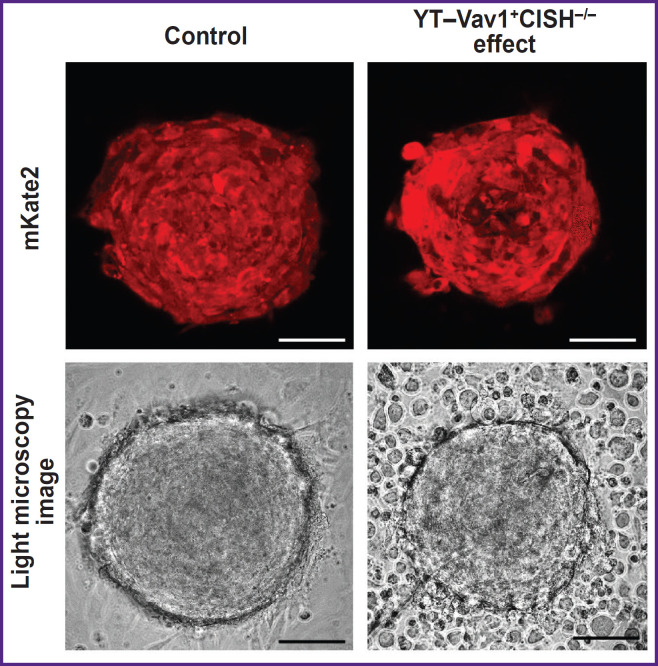 Efficacy Evaluation of "Enhanced" Natural Killers with <i>CISH</i> and <i>B2M</i> Knockouts on Viability and Metabolic Status of 3D Glioblastoma Spheroid Cells in Patients.