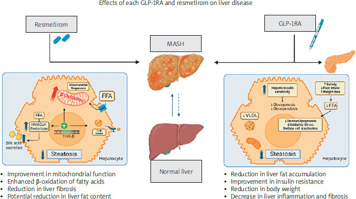 Exploring synergistic therapy for metabolic dysfunction-associated steatotic liver disease.