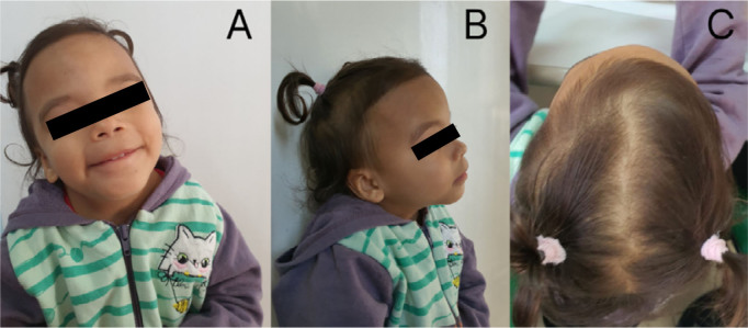 Jacobsen syndrome associated with Shone's complex: a case report.