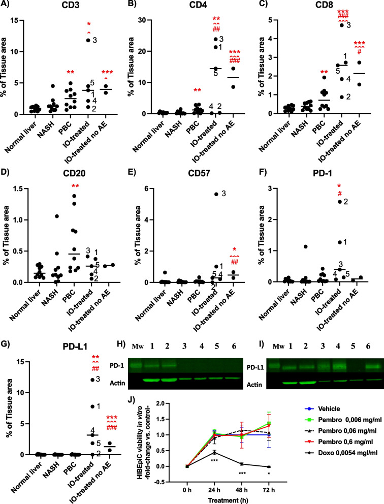 Increased PD-1 expression in livers associated with PD-1-antibody-induced hepatotoxicity.