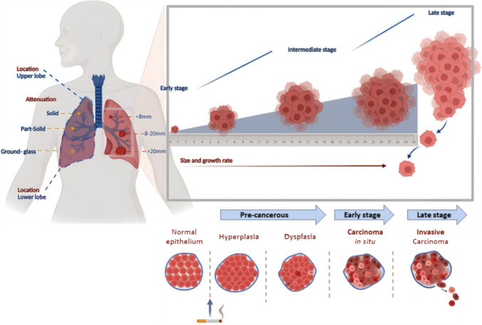 Minimally invasive biomarkers for triaging lung nodules-challenges and future perspectives.