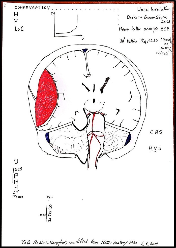 Acute Epidural Hematoma: From Injury to Death.