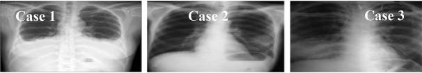 Pulmonary Cryptosporidiosis in HIV Infected Patients at Imam Khomeini Complex Hospital in Tehran, Iran: A Case Series.
