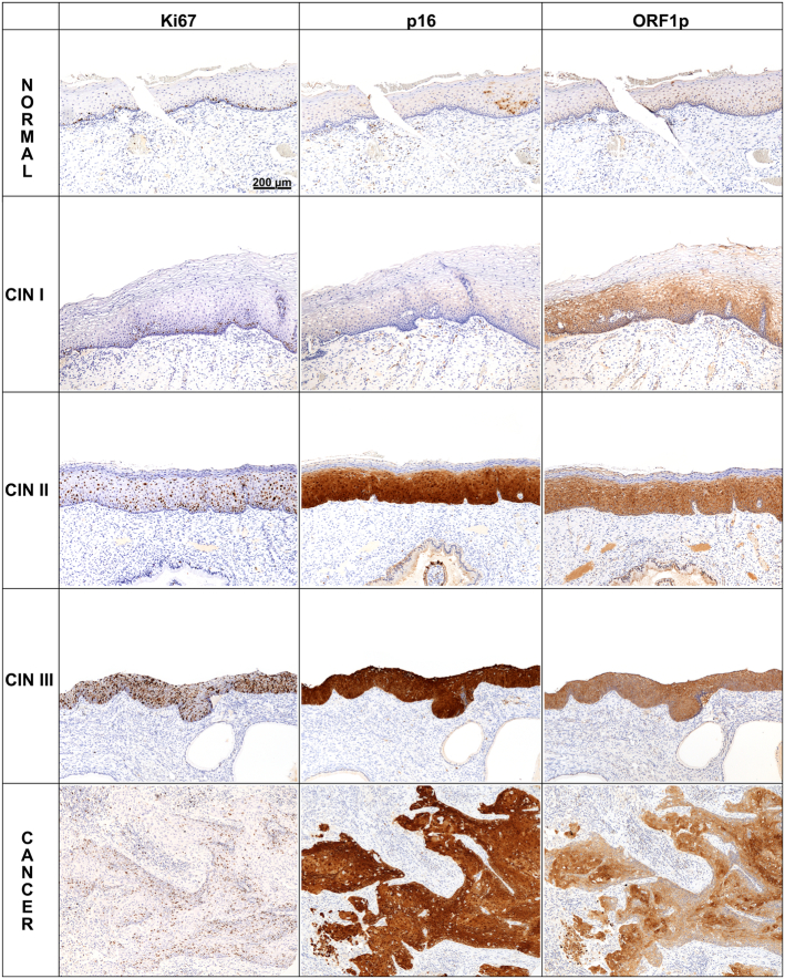 LINE-1 ORF1p is a Promising Biomarker in Cervical Intraepithelial Neoplasia Degree Assessment.
