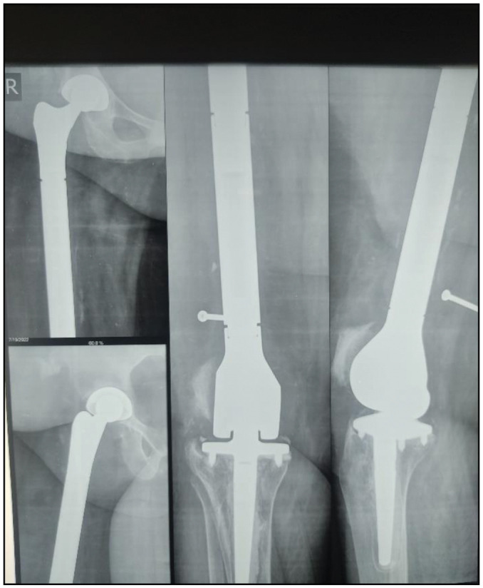 Total Femur Replacement as a Salvage Procedure for Failed Distal Femur Megaprosthesis: A Case Report and Literature Reviews.