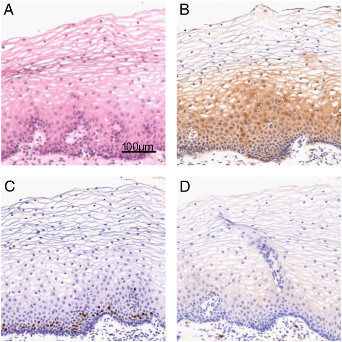 LINE-1 ORF1p is a Promising Biomarker in Cervical Intraepithelial Neoplasia Degree Assessment.