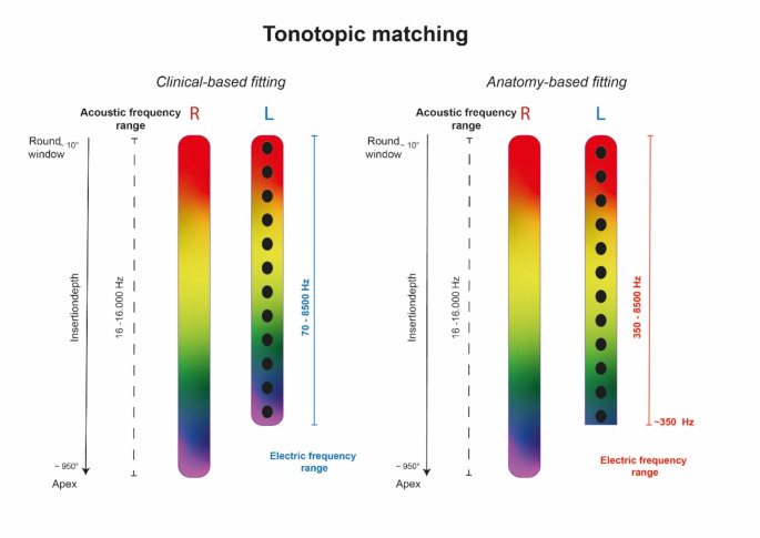 Anatomy-based fitting improves speech perception in noise for cochlear implant recipients with single-sided deafness.