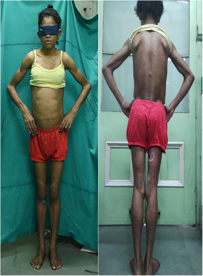 A very low carbohydrate diet improved metabolic profile in congenital generalized lipodystrophy type 4.