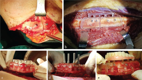 Fully Digital Workflow for Immediate Prosthetic Implant on Microsurgery Fibula Flap for Mandibular Reconstruction.