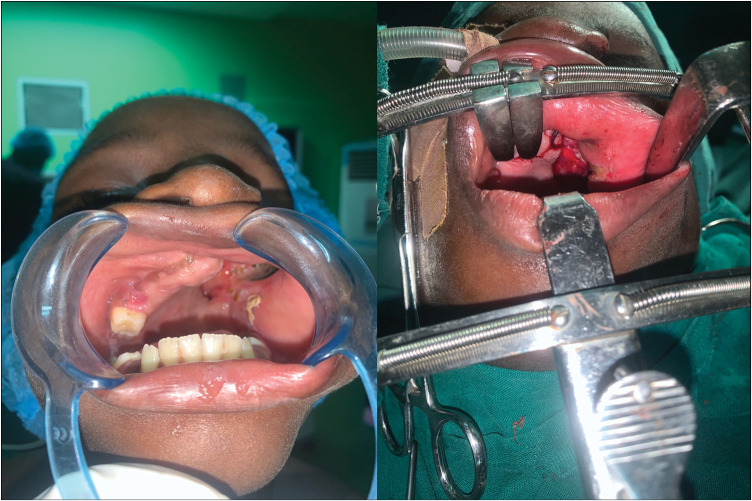 Role of Local Flaps in the Reconstruction of Extensive Anterolateral Noma Defect: A Case Report.