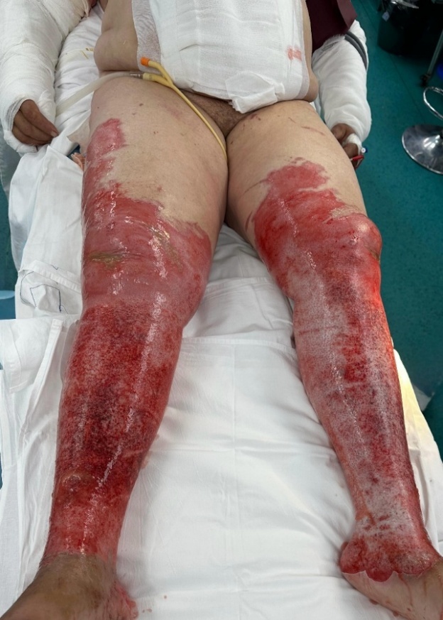 Burn Debridment - Approach and Review.