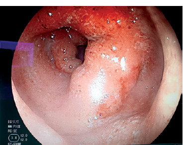 New challenges in the management of inflammatory bowel disease: a case study.