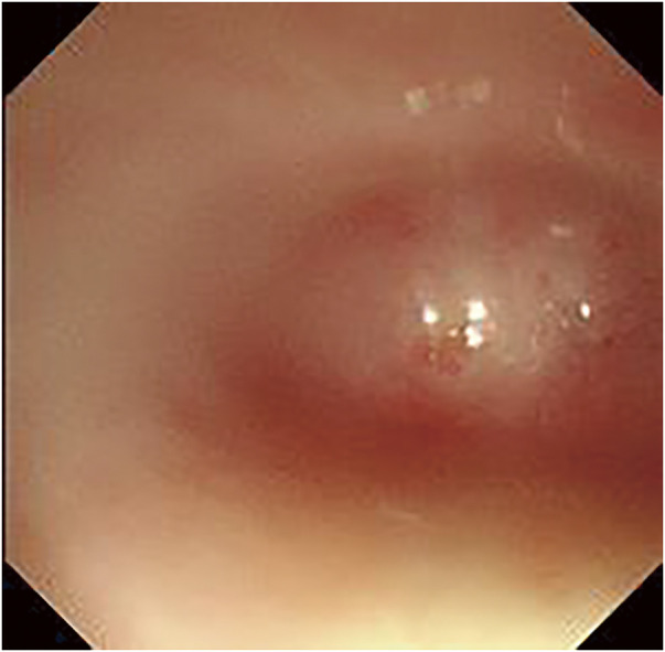 Esophageal Atresia Caused by Corrosive Esophagitis for over 50 Years: A Case Report.