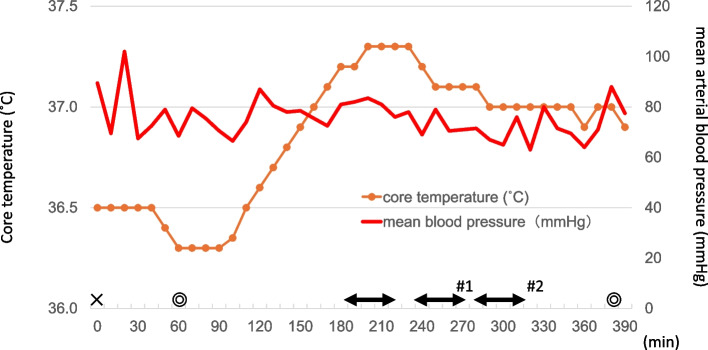 Intraoperative vascular anastomosis occlusion due to cold agglutinin disease during brain surgery: a case report.