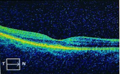 Uncommon Therapeutic Approaches for Patients with Recurrent Central Serous Chorioretinopathy: case report and literature review.
