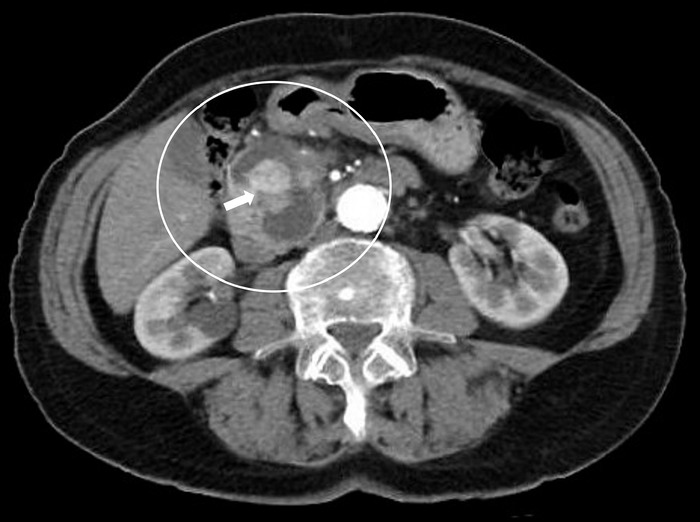Late Pancreatic Metastasis From Papillary Thyroid Carcinoma Diagnosed by Endoscopic Ultrasound-Guided Tissue Acquisition.