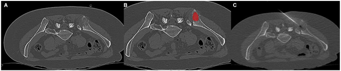 CT Texture Analysis in Breast Cancer Patients Undergoing CT-Guided Bone Biopsy: Correlations With Histopathology.