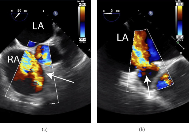 An Early Presentation of Tricuspid Valve Rupture in a Trauma Patient With Congenital Heart Disease.