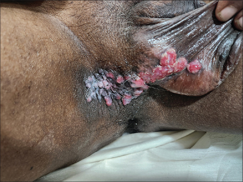 Whether reactivation of granuloma inguinale can be a possibility in a person living with HIV?