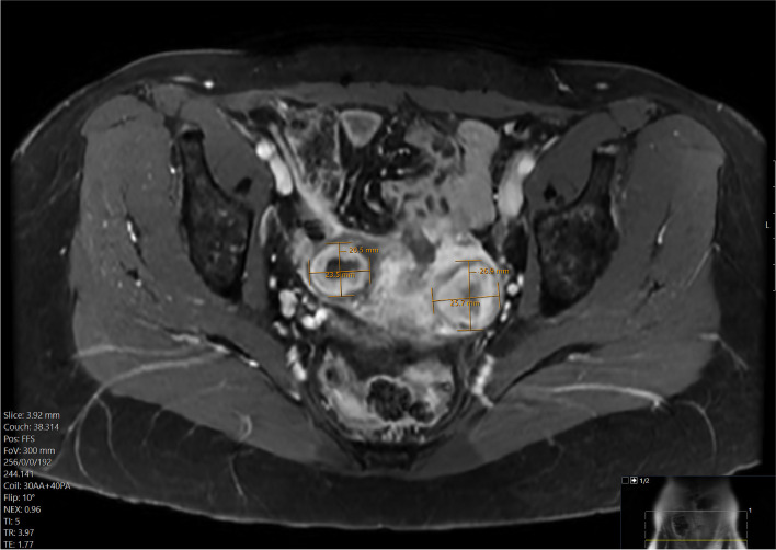 Novel pain management strategy for uterine fibroid embolization.