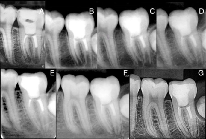 The Impact of Vital Pulp Therapy on Normal Root Development in Immature Teeth: A Case Report.