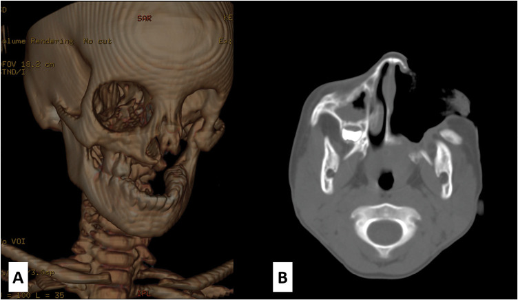 Role of Local Flaps in the Reconstruction of Extensive Anterolateral Noma Defect: A Case Report.