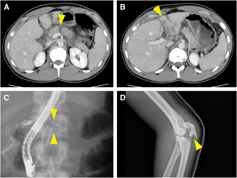 Middle Pancreatectomy for Traumatic Main Pancreatic Duct Injury with Delayed Presentation: Two Case Series.