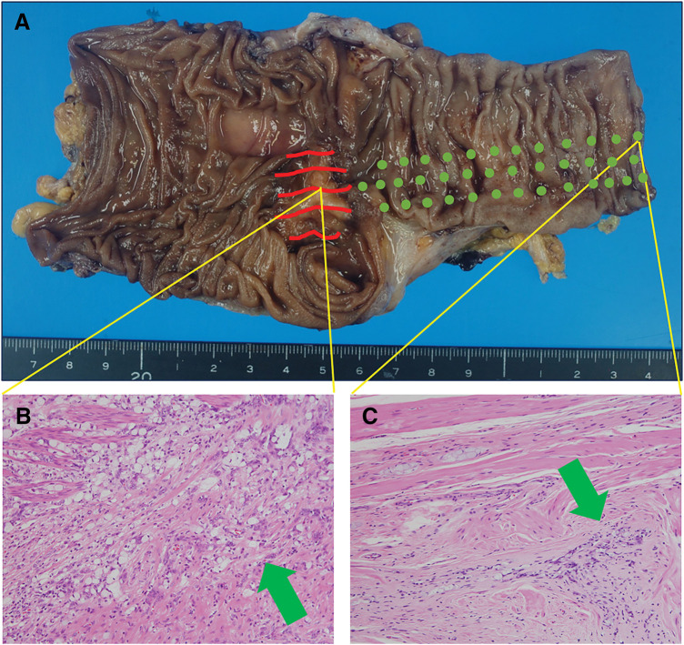 Rare Case of Additional Ileocecal Resection for Ascending Colon Cancer with R1 Resection due to Advanced Perineural Invasion.