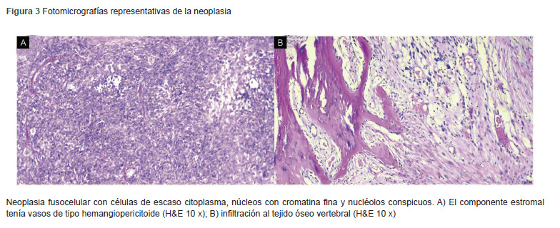 [Doege-Potter syndrome and intra-abdominal giant solitary fibrous tumor: Case report].