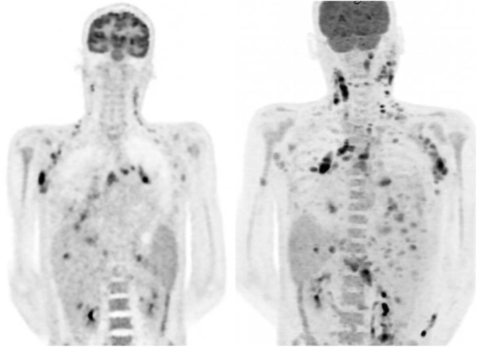 Disseminated nontuberculous mycobacterial infection in the context of interferon-gamma autoantibody syndrome: A case report and review of the literature.