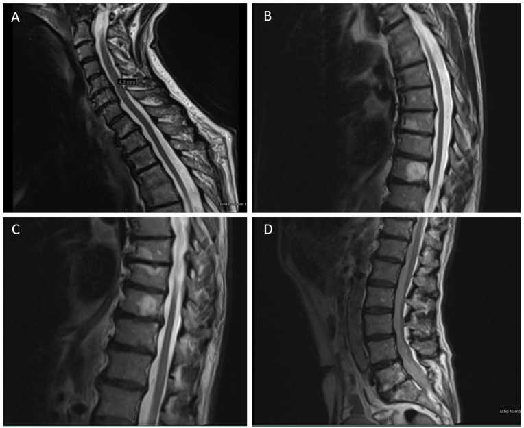 Novel <i>SPAST</i> Deletion Mutation in an American Family With Hereditary Spastic Paraplegia: A Case Report.