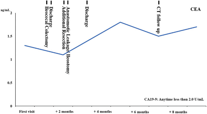 Rare Case of Additional Ileocecal Resection for Ascending Colon Cancer with R1 Resection due to Advanced Perineural Invasion.