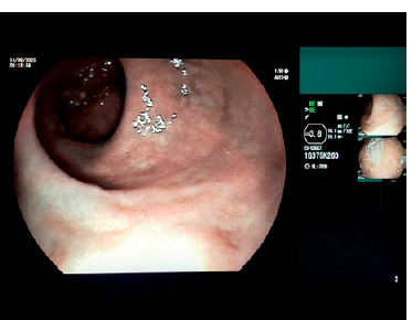 New challenges in the management of inflammatory bowel disease: a case study.