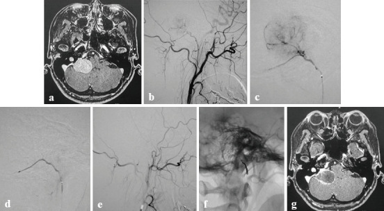 Embosphere Size Selection and Dilution Rate in Preoperative Tumor Embolization of the External Carotid Artery System Using a Small-diameter Catheter.