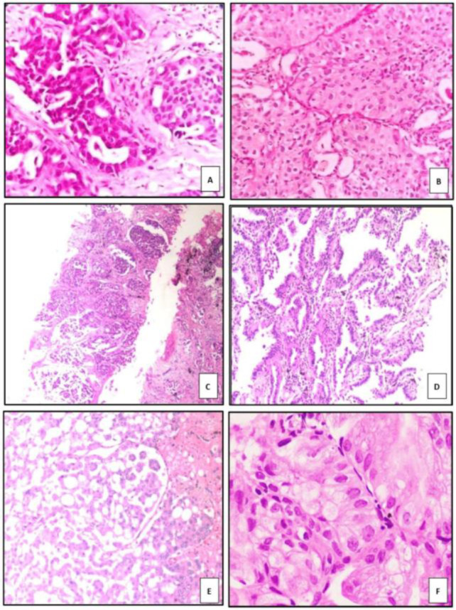 Evaluation of TTF-1, Napsin A, p40, and p63 in the Subtyping of Non-Small Cell Lung Carcinoma: A Cross-Sectional Study from India.