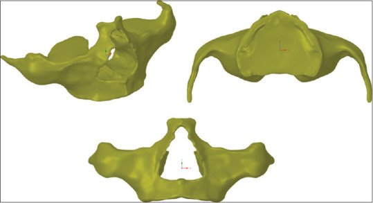 Biomechanical Behaviour of Quad Zygoma Technique Using a Smooth Body Zygomatic Implant and Angled Abutments - An <i>In Vitro</i> Study.