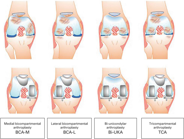 Current status of bicompartmental arthroplasty.