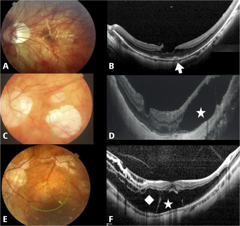 Management of myopic traction maculopathy.