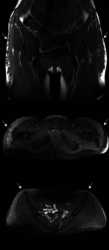 Aquafilling Filler for Buttock Augmentation Cause Severe Long-Term Complications: A Case Report.