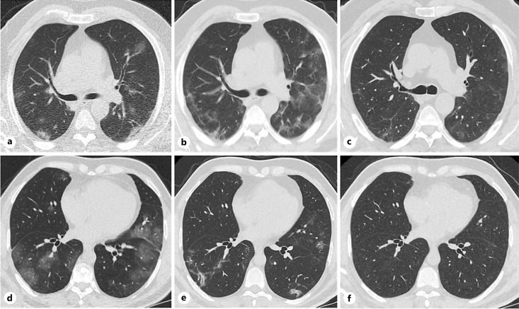 Inhaled Aviptadil Is a New Hope for Recovery of Lung Damage due to COVID-19.
