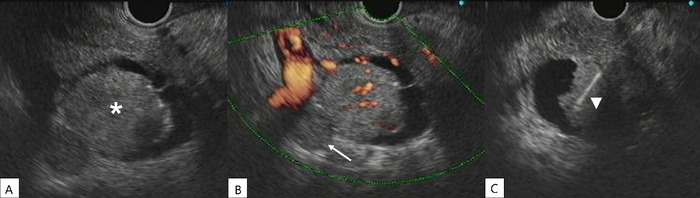 Late Pancreatic Metastasis From Papillary Thyroid Carcinoma Diagnosed by Endoscopic Ultrasound-Guided Tissue Acquisition.