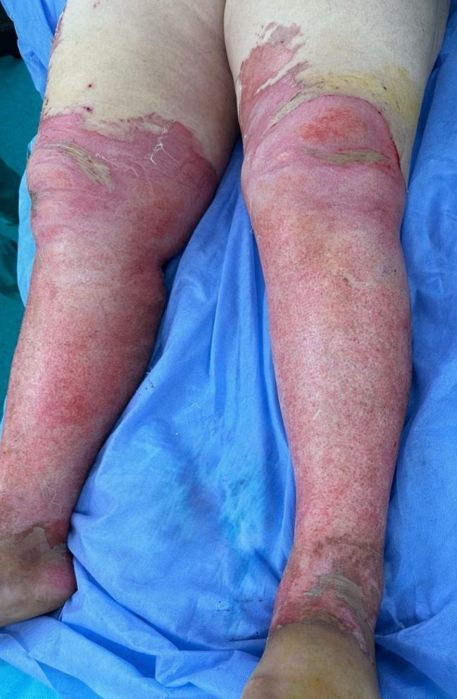 Burn Debridment - Approach and Review.