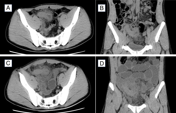 A Case of Appendicitis Due to Burkitt Lymphoma Masking the Systemic Symptoms of Rapidly Progressing Burkitt Lymphoma.